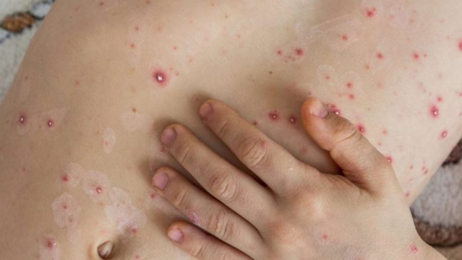 Mpox: MS investiga dois casos suspeitos e descarta um; estado monitora avanço da doença